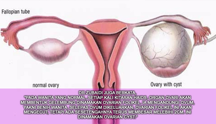 Perlukah Ovarian Cyst Dibedah? Ini Adalah Tanda-Tanda Fibroid Dan Cyst Dalam Rahim Yang Bermasalah